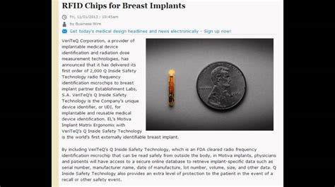 rfid tagging in breast surgery